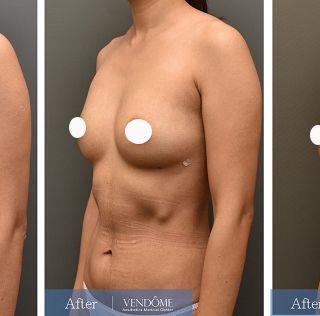 療程效果因人而異，上圖為B罩杯產後女性在做完自體脂肪隆乳之後​手術後一個月、手術後六個月成效